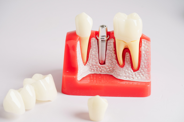 Are Dental Implants Safe?