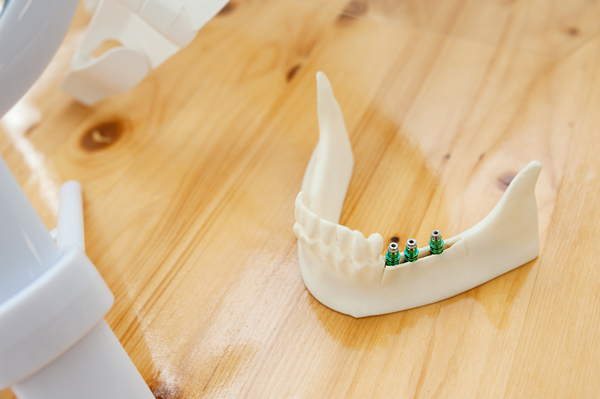 An Implant Dentist Discusses Implant Placement Into The Jawbone