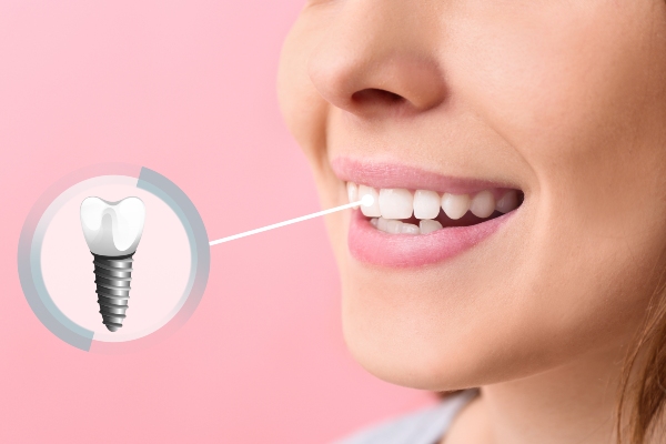 Pros And Cons Of Dental Implants